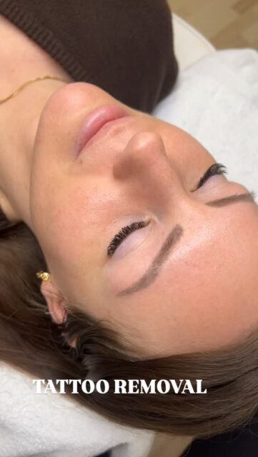 Har du gammel permanent makeup eller en tatovering du ikke længere ønsker? Kom ind forbi klinikken, eller bestil tid til en konsultation 📃🤍

#tattooremoval#aarhus#tatoveringsfjernelse#pmu