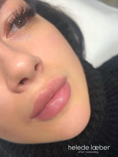 Helede læber efter 1. behandling 💋 swipe for at se hvordan de så ud før, og lige efter behandling 💉
